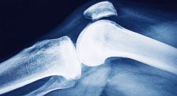 L’ostéoporose: l’autre fardeau silencieux