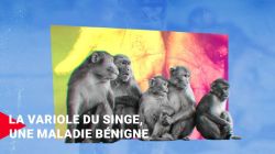 La variole du singe, une maladie bénigne