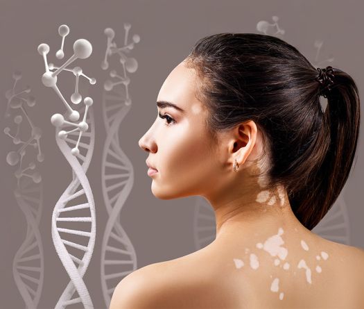 Vitiligo au Liban: entre tabous et parcours de soins