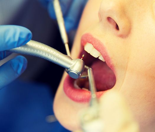 Un vaccin contre les caries? Des chercheurs franchissent un cap