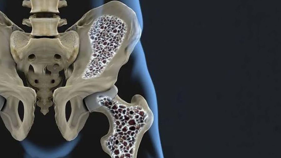 Ostéoporose: au Liban, ne pas attendre la fracture
