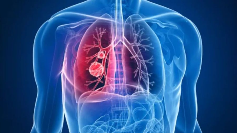 Cancer du poumon: au Liban, le souffle court de la prévention